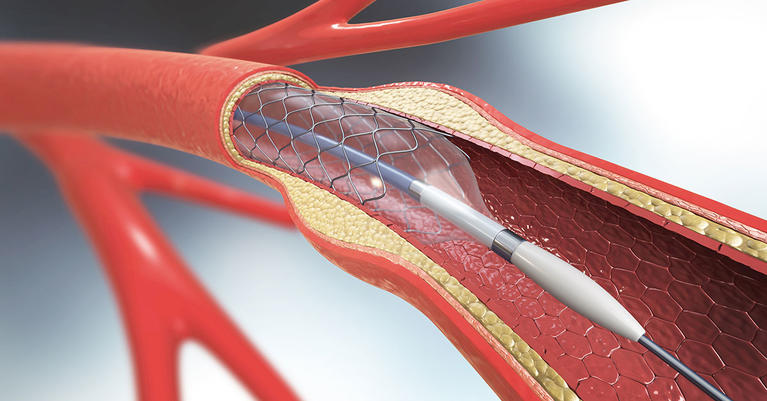 <span class="entry-title-primary">Carotid Stent Market Size – Industry Growth Report 2025</span> <span class="entry-subtitle">Carotid Stent Market Research Report 2019</span><span class="rating-result after_title mr-filter rating-result-30967">	<span class="mr-star-rating">			    <i class="fa fa-star mr-star-full"></i>	    	    <i class="fa fa-star mr-star-full"></i>	    	    <i class="fa fa-star mr-star-full"></i>	    	    <i class="fa fa-star mr-star-full"></i>	    	    <i class="fa fa-star mr-star-full"></i>	    </span><span class="star-result">	5/5</span>			<span class="count">				(1)			</span>			</span>