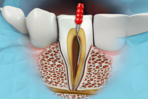 <span class="entry-title-primary">Dental Endodontics Market Report:Outlook, Analysis, Size, Share and Forecast 2019 – 2025</span> <span class="entry-subtitle">Global Dental Endodontics Market Growth:</span>