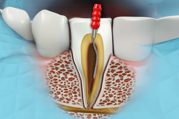 <span class="entry-title-primary">Dental Endodontics Market Report:Outlook, Analysis, Size, Share and Forecast 2019 – 2025</span> <span class="entry-subtitle">Global Dental Endodontics Market Growth:</span><span class="rating-result after_title mr-filter rating-result-28029">	<span class="mr-star-rating">			    <i class="fa fa-star mr-star-full"></i>	    	    <i class="fa fa-star mr-star-full"></i>	    	    <i class="fa fa-star mr-star-full"></i>	    	    <i class="fa fa-star mr-star-full"></i>	    	    <i class="fa fa-star mr-star-full"></i>	    </span><span class="star-result">	5/5</span>			<span class="count">				(1)			</span>			</span>