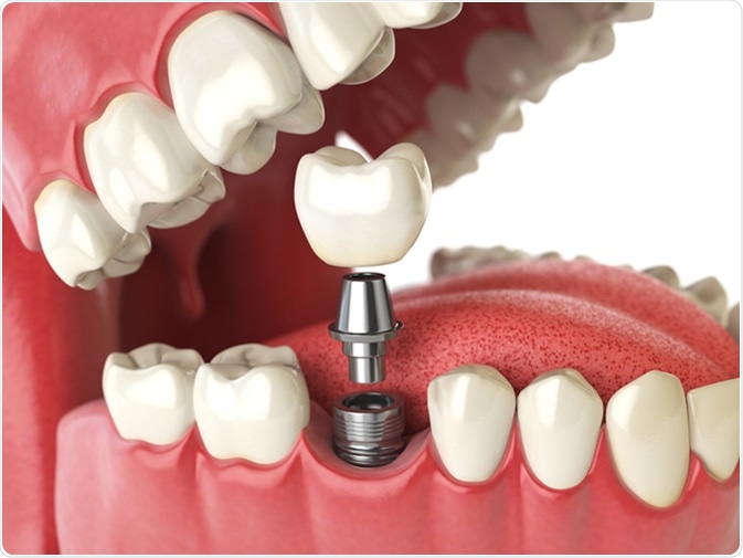 <span class="entry-title-primary">Dental Implants and Prosthesis Market | Industry Trends, Regulations</span> <span class="entry-subtitle">Global Dental Implants and Prosthesis Market Growth:</span><span class="rating-result after_title mr-filter rating-result-30666">			<span class="no-rating-results-text">No ratings yet.</span>		</span>