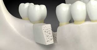 <span class="entry-title-primary">Dental Membrane and Bone Graft Substitutes Market Trends, Analysis Report 2025</span> <span class="entry-subtitle">Dental Membrane and Bone Graft Substitutes Market –Outlook</span><span class="rating-result after_title mr-filter rating-result-28936">			<span class="no-rating-results-text">No ratings yet.</span>		</span>