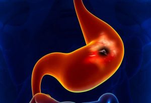 Gastric cancer therapy Market Size, Growth, Trends, Share and Analysis