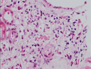<span class="entry-title-primary">Hypereosinophilic Syndrome Market: Global Key Players, Trends, Industry Size, Growth, Forecast To 2028</span> <span class="entry-subtitle">Global Hypereosinophilic Syndrome Market</span>