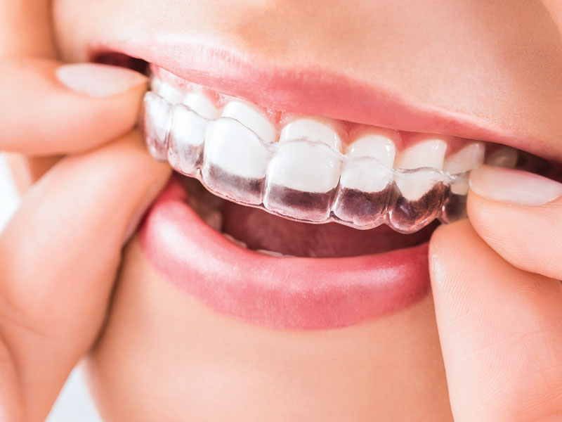 <span class="entry-title-primary">Global Invisible Braces Market: Allied Market Research</span> <span class="entry-subtitle">Invisible Braces Market Research: </span><span class="rating-result after_title mr-filter rating-result-30359">	<span class="mr-star-rating">			    <i class="fa fa-star mr-star-full"></i>	    	    <i class="fa fa-star mr-star-full"></i>	    	    <i class="fa fa-star mr-star-full"></i>	    	    <i class="fa fa-star mr-star-full"></i>	    	    <i class="fa fa-star mr-star-full"></i>	    </span><span class="star-result">	5/5</span>			<span class="count">				(1)			</span>			</span>