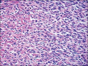 <span class="entry-title-primary">Neurofibrosarcoma Market Research Report and Expert Segment Summary Forecast To 2025</span> <span class="entry-subtitle">Global Neurofibrosarcoma Market</span>