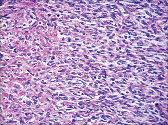 <span class="entry-title-primary">Neurofibrosarcoma Market Research Report and Expert Segment Summary Forecast To 2025</span> <span class="entry-subtitle">Global Neurofibrosarcoma Market</span><span class="rating-result after_title mr-filter rating-result-30687">	<span class="mr-star-rating">			    <i class="fa fa-star mr-star-full"></i>	    	    <i class="fa fa-star mr-star-full"></i>	    	    <i class="fa fa-star mr-star-full"></i>	    	    <i class="fa fa-star mr-star-full"></i>	    	    <i class="fa fa-star mr-star-full"></i>	    </span><span class="star-result">	5/5</span>			<span class="count">				(1)			</span>			</span>