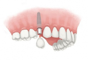 <span class="entry-title-primary">Global Single Tooth Implants and Dental Bridges Market Research Report 2025 | PMR</span> <span class="entry-subtitle">Single Tooth Implants and Dental Bridges Market Research</span>