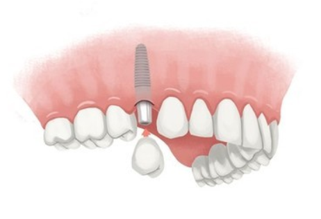 <span class="entry-title-primary">Global Single Tooth Implants and Dental Bridges Market Research Report 2025 | PMR</span> <span class="entry-subtitle">Single Tooth Implants and Dental Bridges Market Research</span><span class="rating-result after_title mr-filter rating-result-27564">	<span class="mr-star-rating">			    <i class="fa fa-star mr-star-full"></i>	    	    <i class="fa fa-star mr-star-full"></i>	    	    <i class="fa fa-star mr-star-full"></i>	    	    <i class="fa fa-star mr-star-full"></i>	    	    <i class="fa fa-star mr-star-full"></i>	    </span><span class="star-result">	5/5</span>			<span class="count">				(1)			</span>			</span>