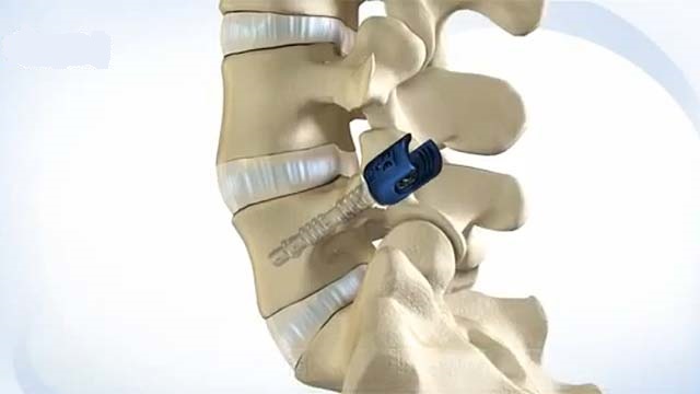 <span class="entry-title-primary">Spine Surgery Device Market Report, Analysis, and Forecast to 2025</span> <span class="entry-subtitle">Global Spine Surgery Device Market Growth:</span><span class="rating-result after_title mr-filter rating-result-28026">			<span class="no-rating-results-text">No ratings yet.</span>		</span>