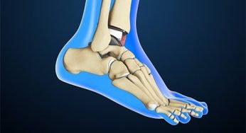 Total Ankle Replacement Market – Analysis and future growth by 2019-2025