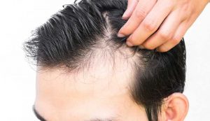 Alopecia treatment hairloss Market Size, Growth, Trends, Share and Analysis