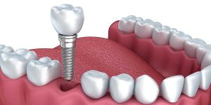 Dental Implants Market: Global Industry Analysis and Opportunity Assessment