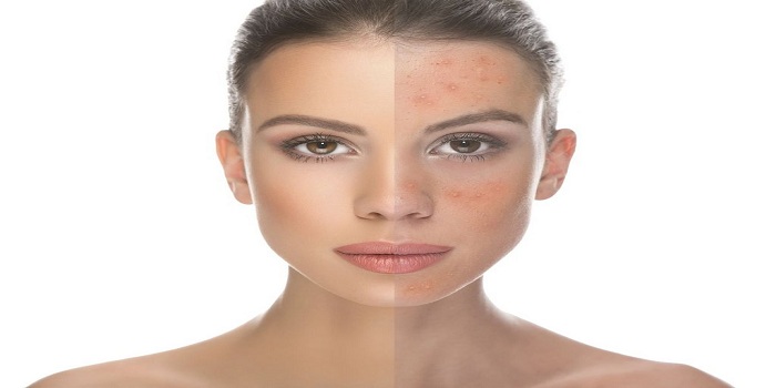 Rosacea Market Size, Share, Trends, and Forecast<span class="rating-result after_title mr-filter rating-result-29040">			<span class="no-rating-results-text">No ratings yet.</span>		</span>