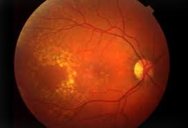 <span class="entry-title-primary">Age Related Macular Degeneration AMD Market Share, Size, Trends, Demand</span> <span class="entry-subtitle">Global Age Related Macular Degeneration AMD Market</span><span class="rating-result after_title mr-filter rating-result-33070">	<span class="mr-star-rating">			    <i class="fa fa-star mr-star-full"></i>	    	    <i class="fa fa-star mr-star-full"></i>	    	    <i class="fa fa-star mr-star-full"></i>	    	    <i class="fa fa-star mr-star-full"></i>	    	    <i class="fa fa-star mr-star-full"></i>	    </span><span class="star-result">	5/5</span>			<span class="count">				(1)			</span>			</span>