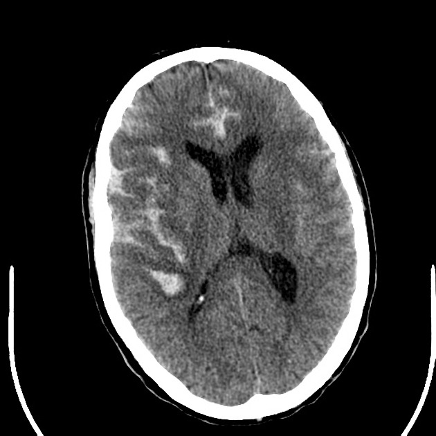 <span class="entry-title-primary">Aneurysmal Subarachnoid Hemorrhage Market Industry Analysis and Forecast to 2024</span> <span class="entry-subtitle">Aneurysmal Subarachnoid Hemorrhage Market size and forecast, 2019</span><span class="rating-result after_title mr-filter rating-result-33067">	<span class="mr-star-rating">			    <i class="fa fa-star mr-star-full"></i>	    	    <i class="fa fa-star mr-star-full"></i>	    	    <i class="fa fa-star mr-star-full"></i>	    	    <i class="fa fa-star mr-star-full"></i>	    	    <i class="fa fa-star mr-star-full"></i>	    </span><span class="star-result">	5/5</span>			<span class="count">				(1)			</span>			</span>