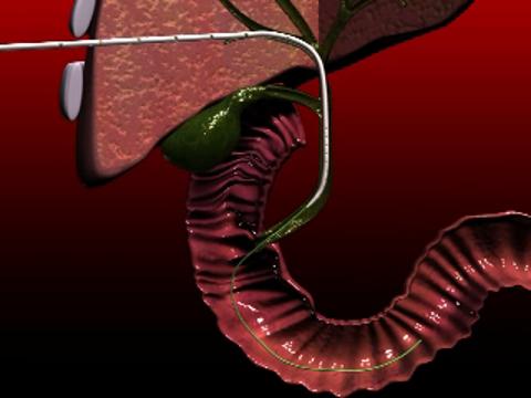 <span class="entry-title-primary">Biliary Drainage Catheters Market 2019 | Worldwide Industry Share, Size</span> <span class="entry-subtitle">Global Biliary Drainage Catheters Market Report</span><span class="rating-result after_title mr-filter rating-result-33948">	<span class="mr-star-rating">			    <i class="fa fa-star mr-star-full"></i>	    	    <i class="fa fa-star mr-star-full"></i>	    	    <i class="fa fa-star mr-star-full"></i>	    	    <i class="fa fa-star mr-star-full"></i>	    	    <i class="fa fa-star mr-star-full"></i>	    </span><span class="star-result">	5/5</span>			<span class="count">				(1)			</span>			</span>