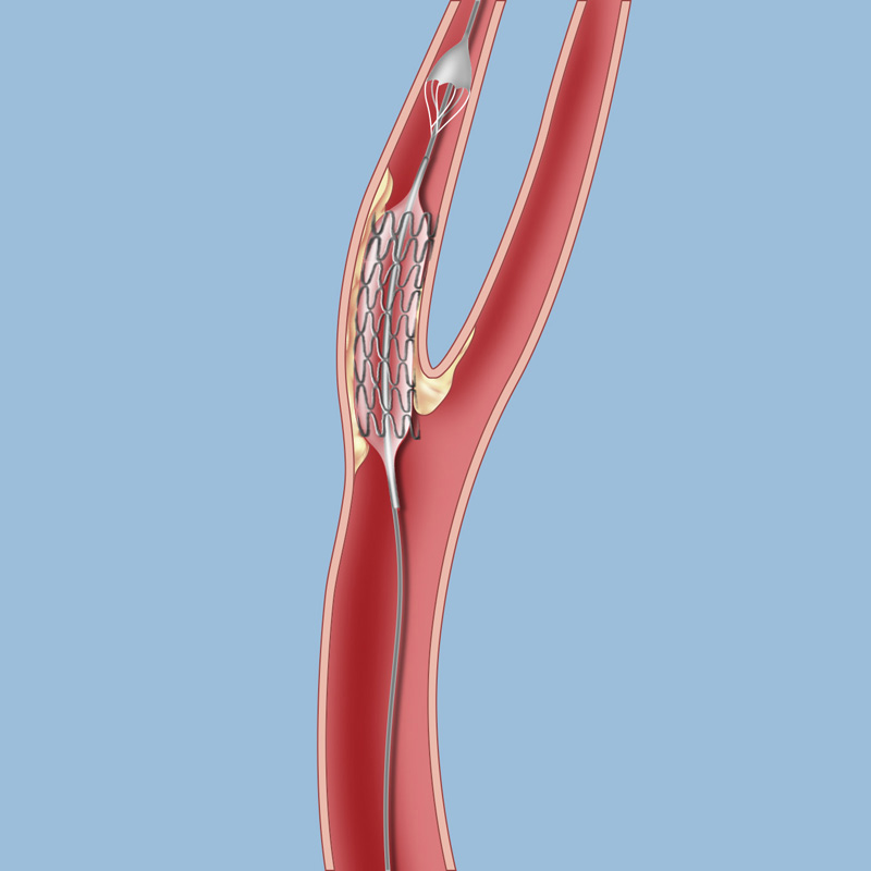 <span class="entry-title-primary">Carotid Artery Stents Market Global Industry Analysis and Forecast 2024</span> <span class="entry-subtitle">Global Carotid Artery Stents Market Research</span><span class="rating-result after_title mr-filter rating-result-32344">	<span class="mr-star-rating">			    <i class="fa fa-star mr-star-full"></i>	    	    <i class="fa fa-star mr-star-full"></i>	    	    <i class="fa fa-star mr-star-full"></i>	    	    <i class="fa fa-star mr-star-full"></i>	    	    <i class="fa fa-star mr-star-full"></i>	    </span><span class="star-result">	5/5</span>			<span class="count">				(1)			</span>			</span>