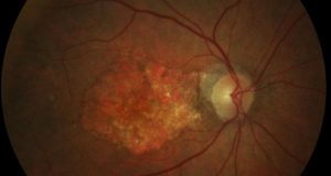 <span class="entry-title-primary">Choroidal Neovascularization Market Insight, Analysis and Market Forecast – 2024</span> <span class="entry-subtitle">Choroidal Neovascularization Market Size, Demand, Trends</span>