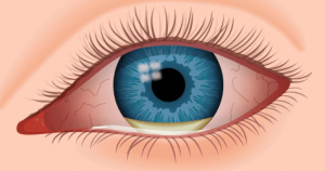 <span class="entry-title-primary">Eye Infections Treatment Market Report, Analysis, and Forecast to 2019-2024</span> <span class="entry-subtitle">Global Eye Infections Treatment Market Research</span>