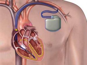 <span class="entry-title-primary">Global Implantable Cardioverter-Defibrillators ICD Market Share by Type 2019-2025</span> <span class="entry-subtitle">Implantable Cardioverter-Defibrillators ICD Market Research</span>