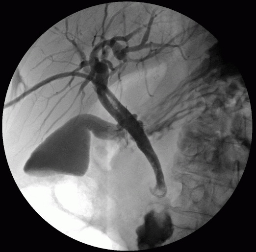 <span class="entry-title-primary">Percutaneous Transhepatic Cholangiography Market SWOT Analysis from 2019-2025</span> <span class="entry-subtitle">Global Percutaneous Transhepatic Cholangiography Market</span><span class="rating-result after_title mr-filter rating-result-32179">	<span class="mr-star-rating">			    <i class="fa fa-star mr-star-full"></i>	    	    <i class="fa fa-star mr-star-full"></i>	    	    <i class="fa fa-star mr-star-full"></i>	    	    <i class="fa fa-star mr-star-full"></i>	    	    <i class="fa fa-star mr-star-full"></i>	    </span><span class="star-result">	5/5</span>			<span class="count">				(1)			</span>			</span>