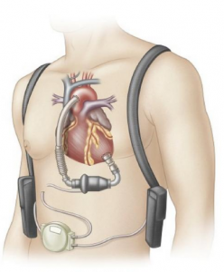 <span class="entry-title-primary">Ventricular Assist Devices VAD Market Growth and Forecasts to 2019-2025</span> <span class="entry-subtitle">Ventricular Assist Devices VAD Market Growth Forecast Report</span>