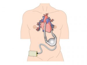 <span class="entry-title-primary">Left Ventricular Assist Device Market Trend, Segmentation And Forecast To 2024</span> <span class="entry-subtitle">Left Ventricular Assist Device Market Research</span>