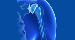 <span class="entry-title-primary">Shoulder Replacement Market – Growth, Trends, Analysis And Forecasts (2019-2025)</span> <span class="entry-subtitle">Global Shoulder Replacement Market Report</span>