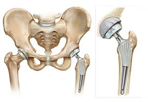 <span class="entry-title-primary">Total Hip Replacement Market Growth Analysis and Forecast To 2025</span> <span class="entry-subtitle">Global Total Hip Replacement Market Report</span>