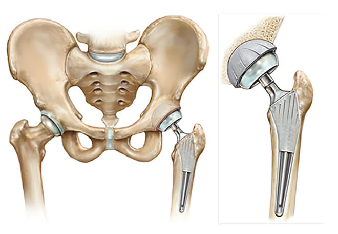 <span class="entry-title-primary">Total Hip Replacement Market Growth Analysis and Forecast To 2025</span> <span class="entry-subtitle">Global Total Hip Replacement Market Report</span><span class="rating-result after_title mr-filter rating-result-34283">	<span class="mr-star-rating">			    <i class="fa fa-star mr-star-full"></i>	    	    <i class="fa fa-star mr-star-full"></i>	    	    <i class="fa fa-star mr-star-full"></i>	    	    <i class="fa fa-star mr-star-full"></i>	    	    <i class="fa fa-star mr-star-full"></i>	    </span><span class="star-result">	5/5</span>			<span class="count">				(1)			</span>			</span>