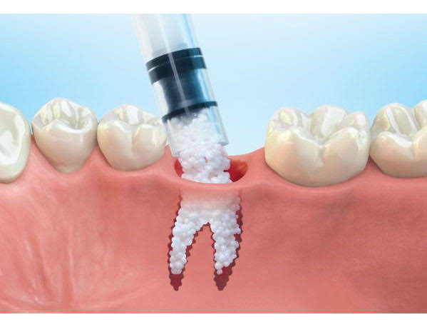 <span class="entry-title-primary">Bone Replacement Material Market Share, Supply, Demand, Segments and Forecast 2019-2024</span> <span class="entry-subtitle">Global Bone Replacement Material Market</span><span class="rating-result after_title mr-filter rating-result-36166">			<span class="no-rating-results-text">No ratings yet.</span>		</span>