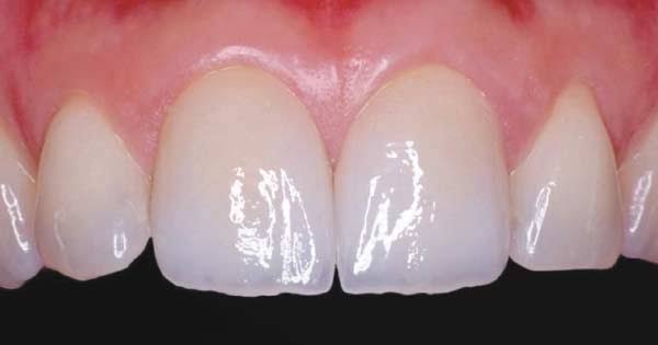 <span class="entry-title-primary">Dental Porcelain Market Overview, Share, Scope, Revenue, Trade Analysis, Trends,</span> <span class="entry-subtitle">Global Dental Porcelain Market Report</span><span class="rating-result after_title mr-filter rating-result-35539">	<span class="mr-star-rating">			    <i class="fa fa-star mr-star-full"></i>	    	    <i class="fa fa-star mr-star-full"></i>	    	    <i class="fa fa-star mr-star-full"></i>	    	    <i class="fa fa-star mr-star-full"></i>	    	    <i class="fa fa-star mr-star-full"></i>	    </span><span class="star-result">	5/5</span>			<span class="count">				(1)			</span>			</span>