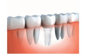 Dental Material Market 2026 by Types, Application, Technology