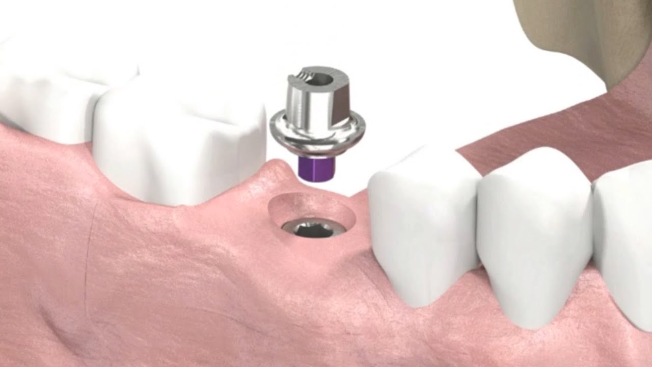 <span class="entry-title-primary">Dental Implants And Prosthetics Market Analysis and Forecast by 2026</span> <span class="entry-subtitle">Global Dental Implants And Prosthetics Market Report</span><span class="rating-result after_title mr-filter rating-result-41417">			<span class="no-rating-results-text">No ratings yet.</span>		</span>