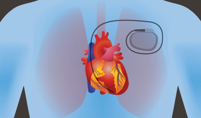 <span class="entry-title-primary">Implantable Cardioverter Defibrillators Market Analysis, Trends, Forecast, 2020-2026</span> <span class="entry-subtitle">Global Implantable Cardioverter Defibrillators Market Report</span><span class="rating-result after_title mr-filter rating-result-41908">			<span class="no-rating-results-text">No ratings yet.</span>		</span>