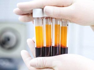 <span class="entry-title-primary">Platelet Rich Plasma (PRP) Market Analysis, Size, Share, Growth, Trends</span> <span class="entry-subtitle">Global Platelet Rich Plasma (PRP) Market Report</span>