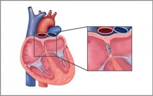 <span class="entry-title-primary">PFO Closure Device Market Growth, Size, Analysis, Outlook</span> <span class="entry-subtitle">Global PFO Closure Device Market Report</span>