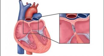PFO Closure Device Market Growth, Size, Analysis, Outlook