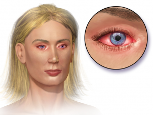 <span class="entry-title-primary">Conjunctivitis Market Review and Forecast 2020 to 2026</span> <span class="entry-subtitle">Global Conjunctivitis Market Report</span>