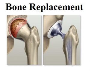 <span class="entry-title-primary">Bone Replacement Market Growth, Trends and Demands Research Report</span> <span class="entry-subtitle">Global Bone Replacement Market Report</span>