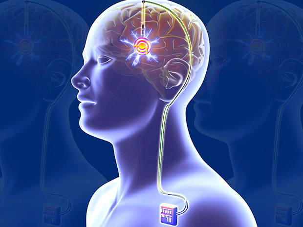 <span class="entry-title-primary">Deep Brain Stimulation Devices Market Industry Analysis, Size and Forecast</span> <span class="entry-subtitle">Global Deep Brain Stimulation Devices Market Report</span><span class="rating-result after_title mr-filter rating-result-45224">			<span class="no-rating-results-text">No ratings yet.</span>		</span>