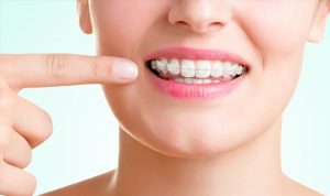 <span class="entry-title-primary">Invisible Braces Market Size, Forecast and Trends by 2020-2026</span> <span class="entry-subtitle">Global Invisible Braces Market Report</span>