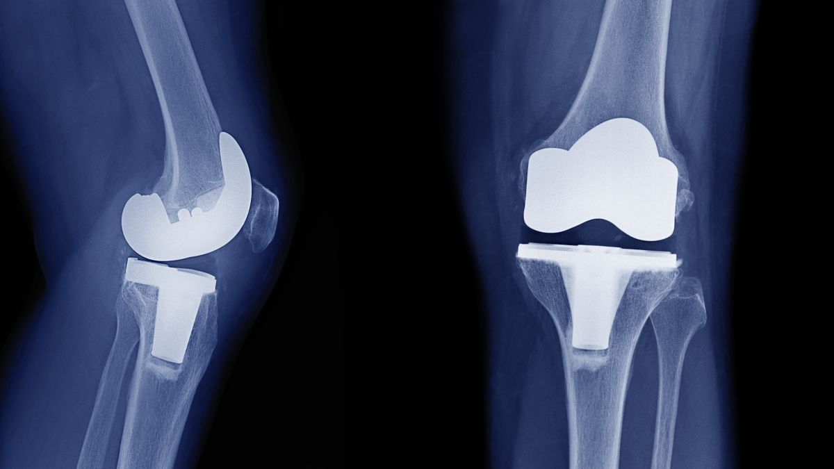 Knee Arthroplasty Market Size, Share, Growth, Trends and Forecast