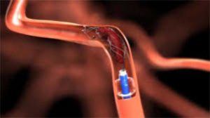 <span class="entry-title-primary">Thrombectomy Devices Market 2020-2025 | Latest Trend, Growth And Forecast</span> <span class="entry-subtitle">Global Thrombectomy Devices Market Report</span>