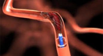 Thrombectomy Devices Market 2020-2025 | Latest Trend, Growth And Forecast