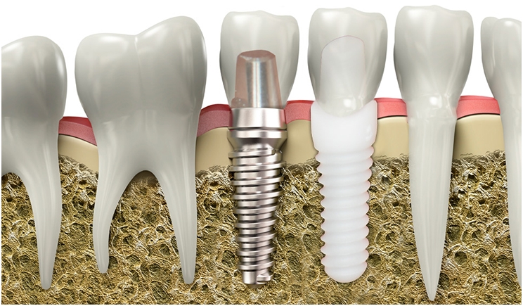 <span class="entry-title-primary">Zirconia Implant Market Analysis and Forecast 2020 – 2026</span> <span class="entry-subtitle">Global Zirconia Implant Market Report</span><span class="rating-result after_title mr-filter rating-result-46582">			<span class="no-rating-results-text">No ratings yet.</span>		</span>