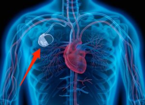 <span class="entry-title-primary">Heart Pacemaker Market by Application and Geography Trends</span> <span class="entry-subtitle">Global Heart Pacemaker Market Report</span>