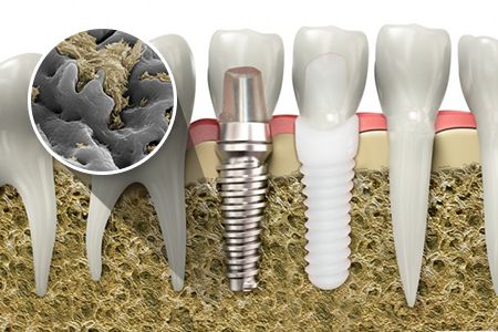 <span class="entry-title-primary">Osseointegration Implants Market Product Scope, Key Players, Trends, Growth Rate</span> <span class="entry-subtitle">Global Osseointegration Implants Market Report</span><span class="rating-result after_title mr-filter rating-result-47470">			<span class="no-rating-results-text">No ratings yet.</span>		</span>